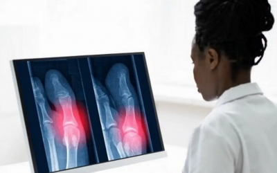 Quand l’IA épaule les professionnels de santé pour détecter les fractures