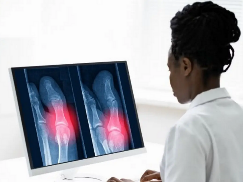 Quand l'IA épaule les professionnels de santé pour détecter les fractures